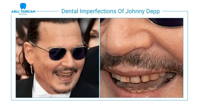 Dental Imperfections Of Johnny Depp