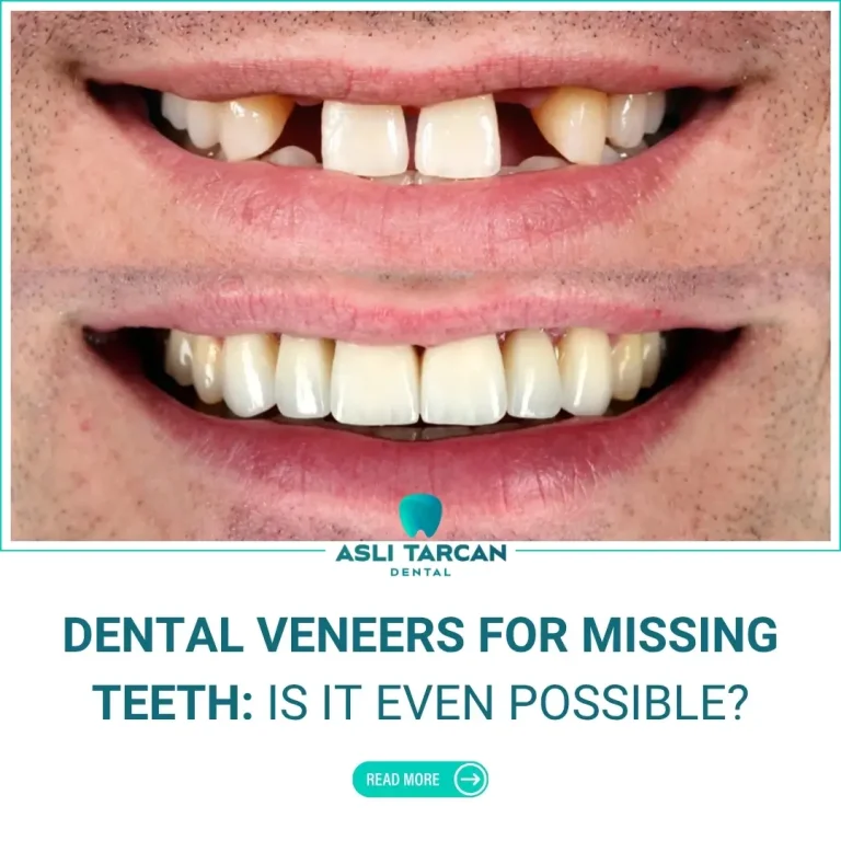 Dental Veneers for Missing Teeth Is It Even Possible