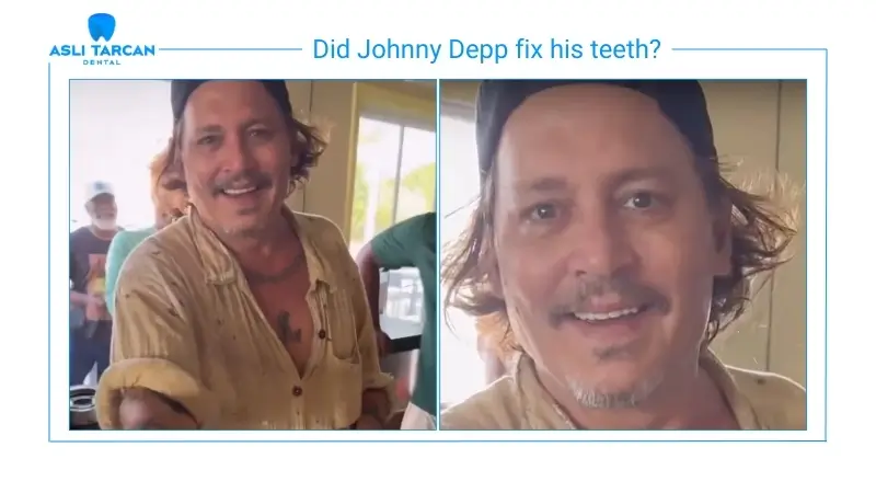 Did Johnny Depp fix his teeth