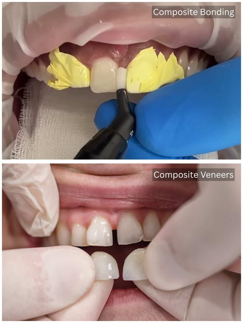 Differences Between Composite Bonding Vs Veneers