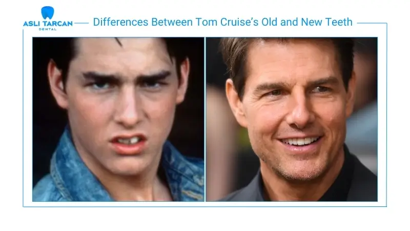 Differences Between Tom Cruise’s Old and New Teeth