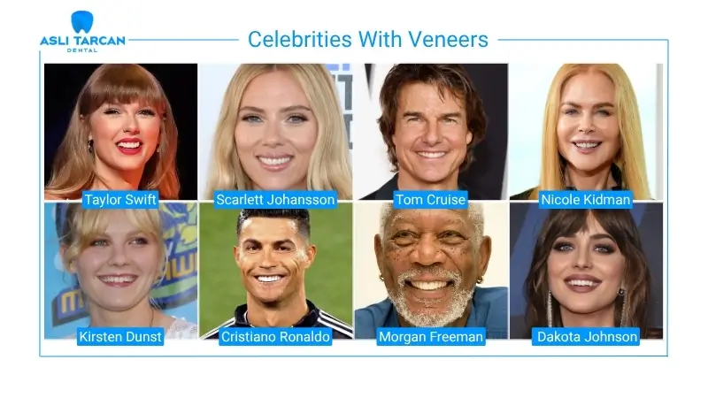 Famous Singers and Actors With Veneers