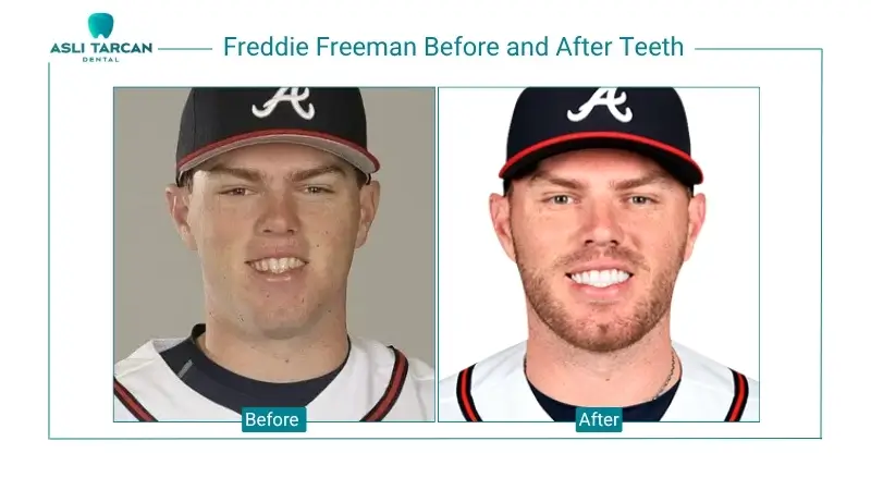 Freddie Freeman Before and After Teeth