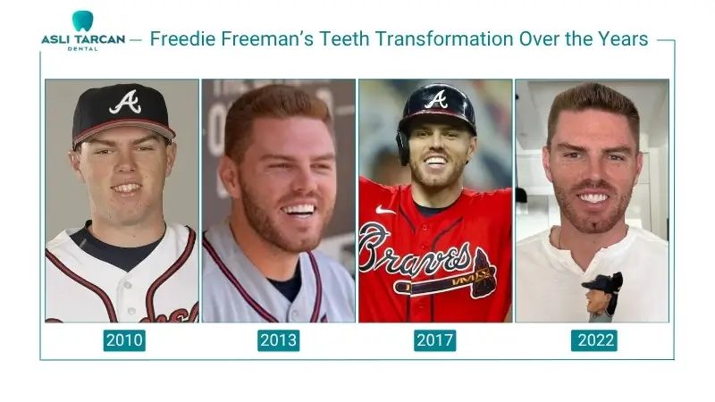 Freedie Freeman’s Teeth Transformation Over the Years