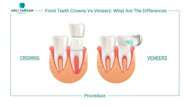 Front Teeth Crowns Vs Veneers What Are The Differences