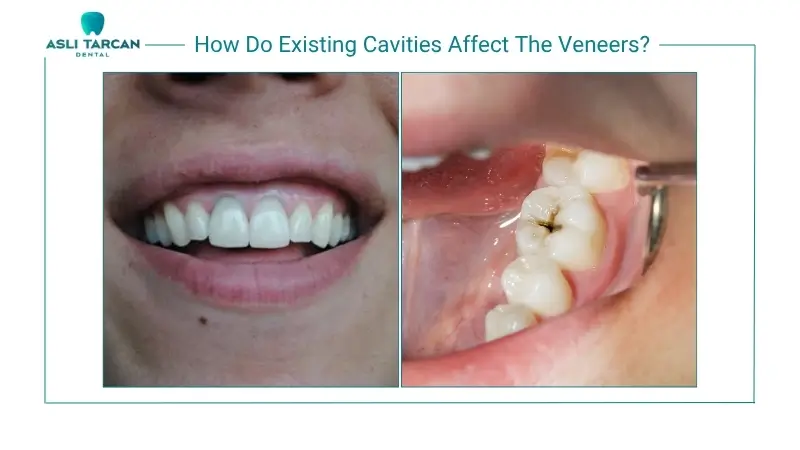 How Do Existing Cavities Affect The Veneers