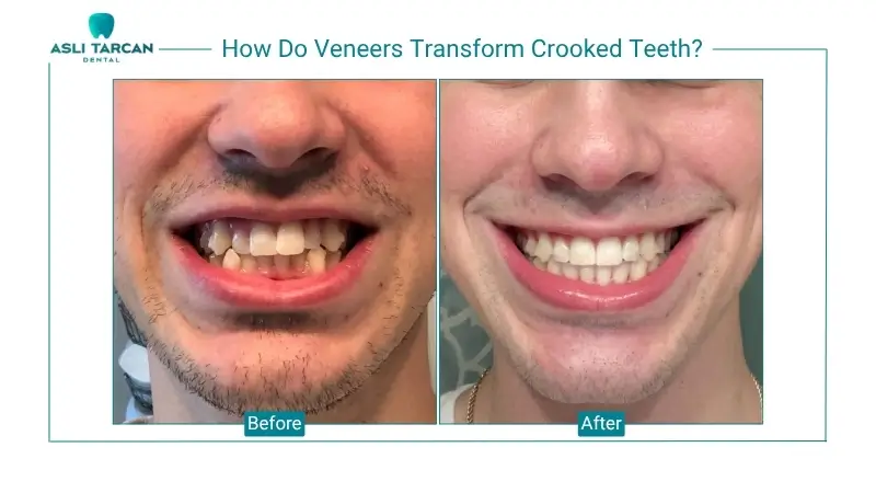 How Do Veneers Transform Crooked Teeth