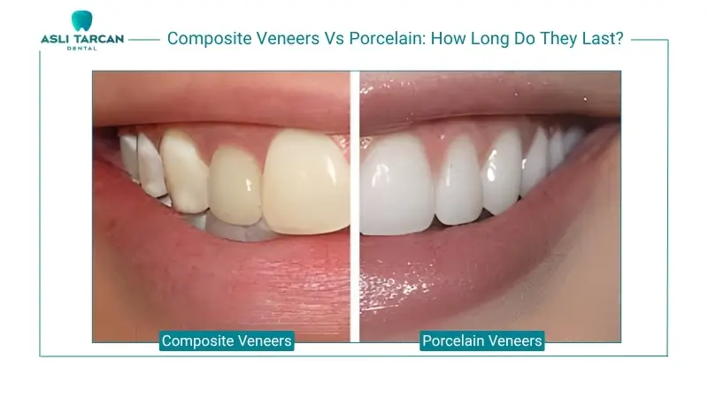 How Long Do Composite Veneers Last