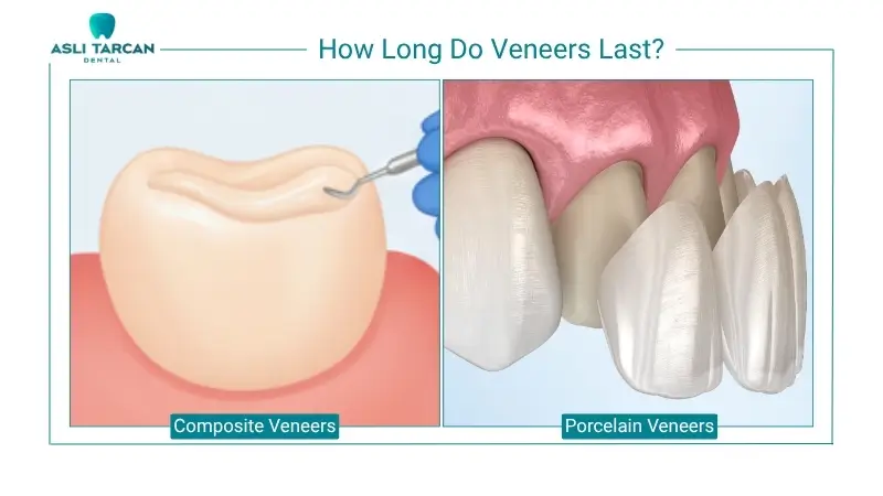 How Long Do Veneers Last