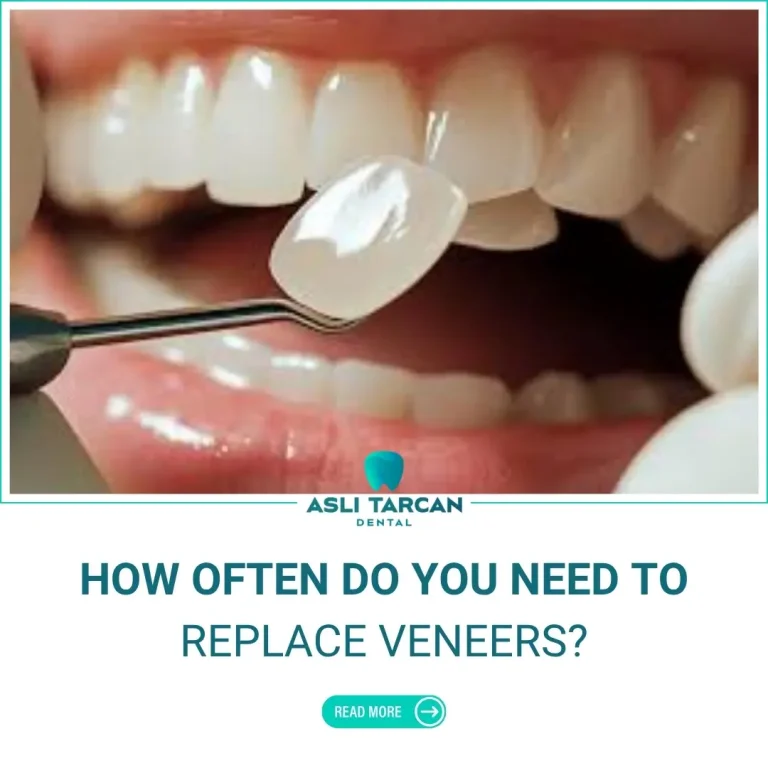 How Often Do You Need To Replace Veneers
