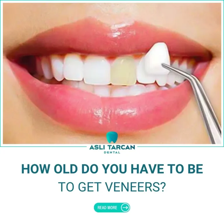 How Old Do You Have to Be to Get Veneers