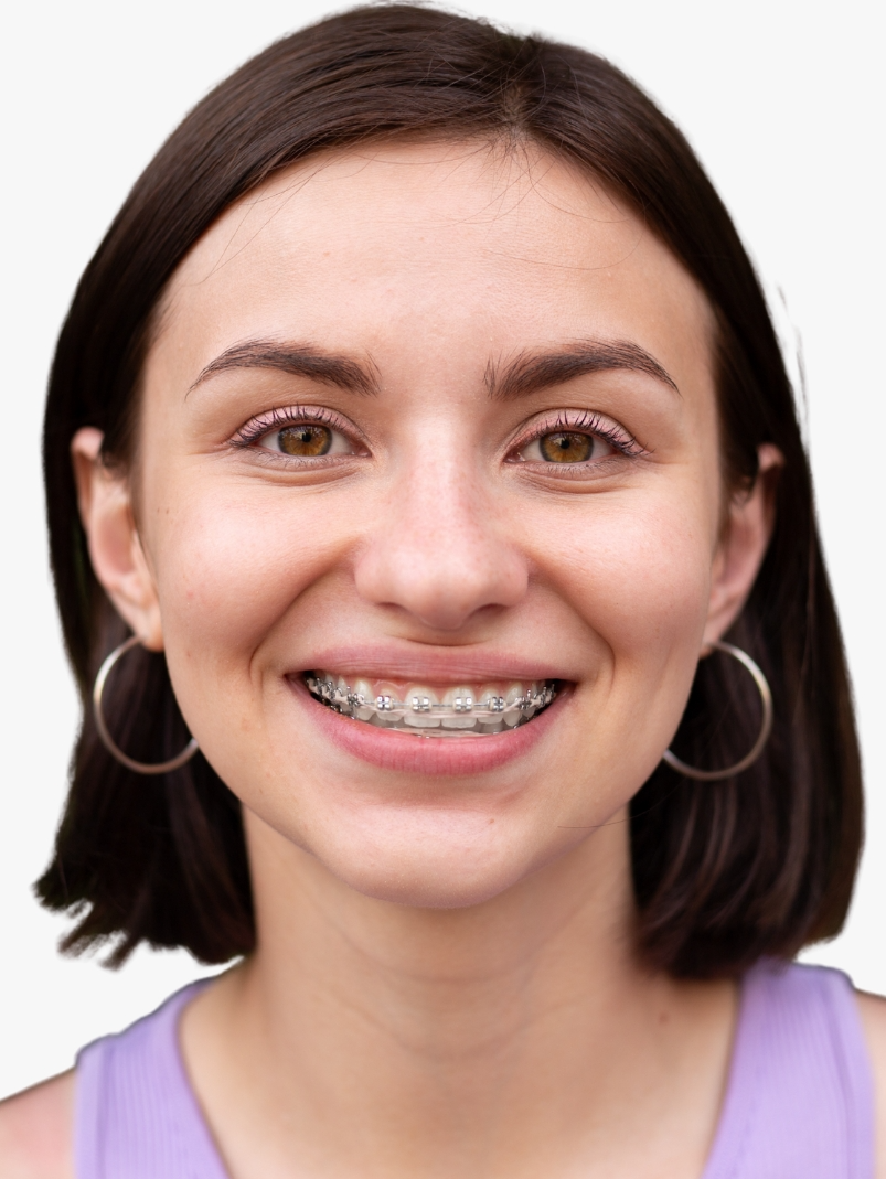 How do Braces Work