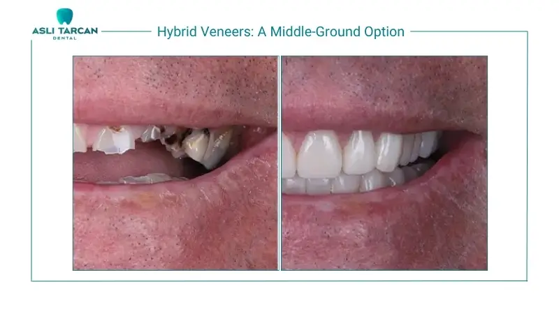 Hybrid Veneers A Middle-Ground Option