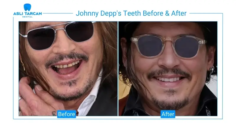 Johnny Depp's Teeth Before & After 