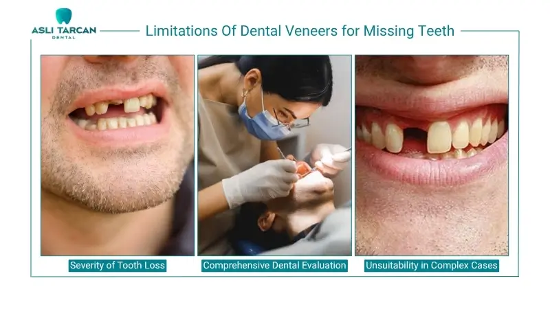 Limitations Of Dental Veneers for Missing Teeth