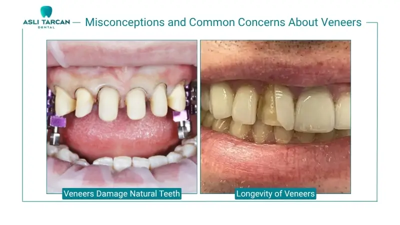 Misconceptions and Common Concerns About Veneers