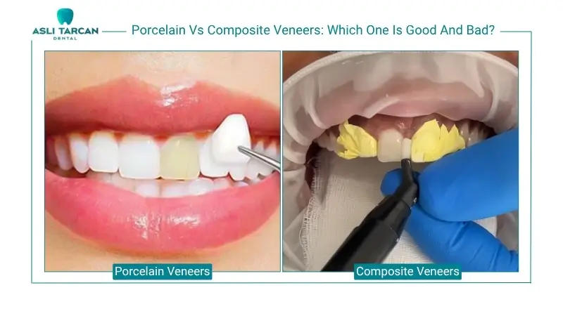 Porcelain Vs Composite Veneers Which One Is Good And Bad