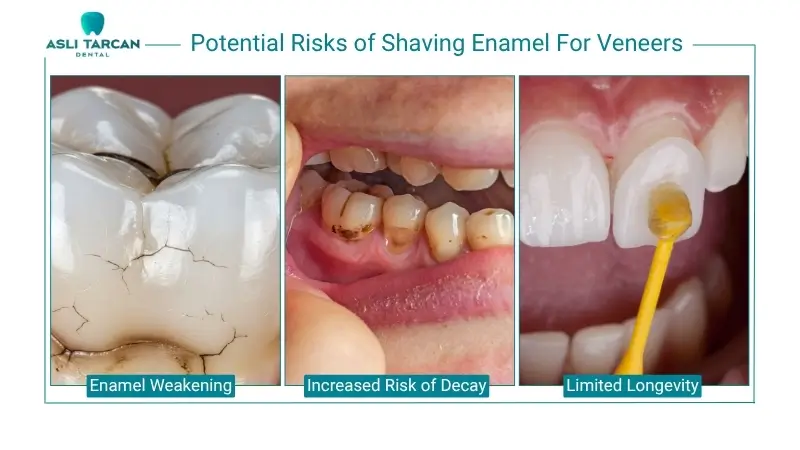 Potential Risks of Shaving Enamel For Veneers
