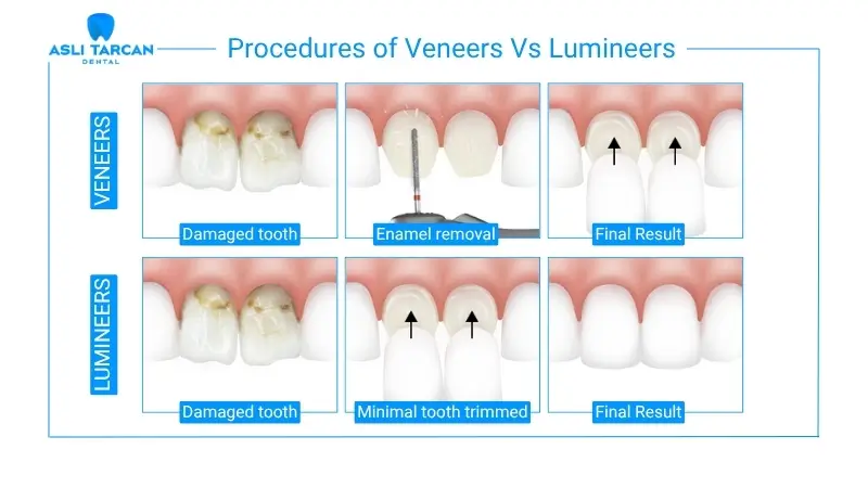 Procedures of Veneers Vs Lumineers