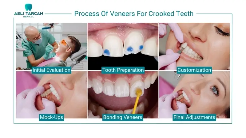 Process Of Veneers For Crooked Teeth