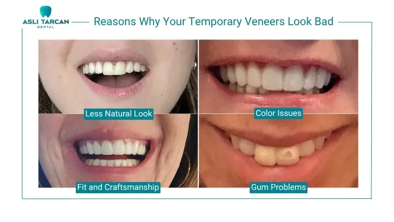 Reasons Why Your Temporary Veneers Look Bad