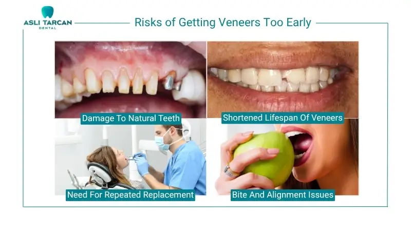 Risks of Getting Veneers Too Early