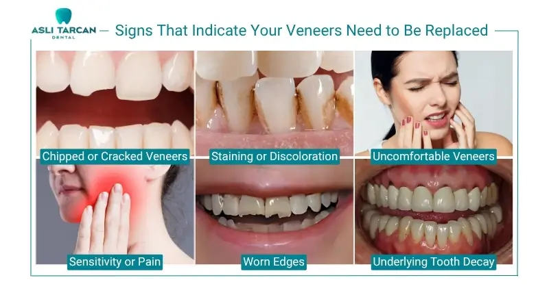 Signs That Indicate Your Veneers Need to Be Replaced