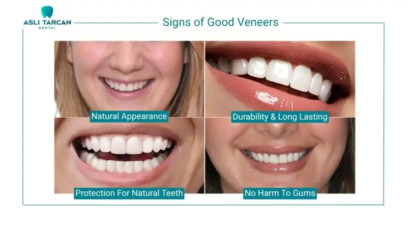 Signs of Good Veneers
