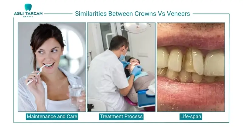 Similarities Between Crowns Vs Veneers