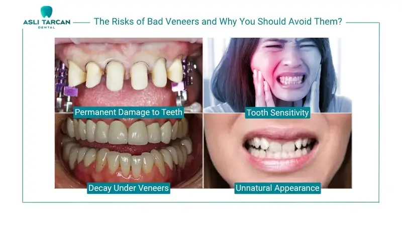 The Risks of Bad Veneers and Why You Should Avoid Them