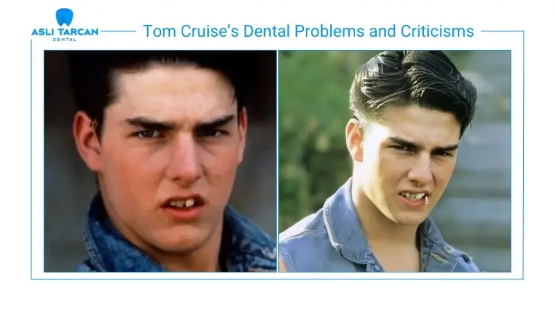 Tom Cruise’s Dental Problems and Criticisms
