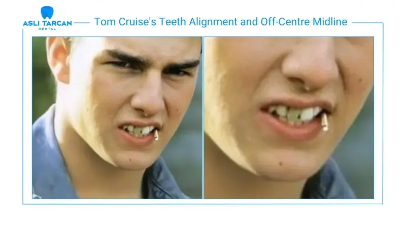 Tom Cruise's Teeth Alignment and Off-Centre Midline