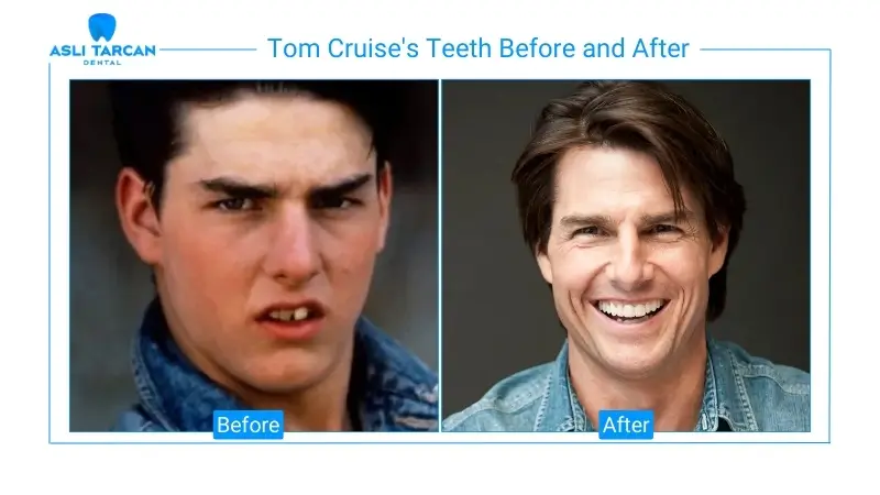 Tom Cruise's Teeth Before and After