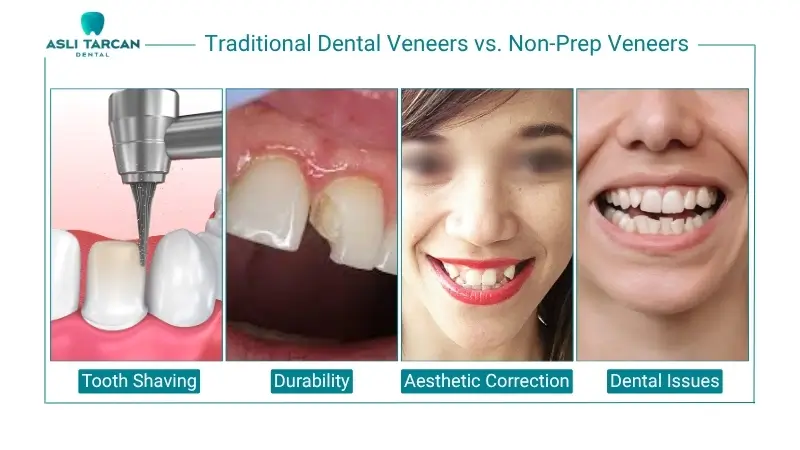 Traditional Dental Veneers vs. Non-Prep Veneers