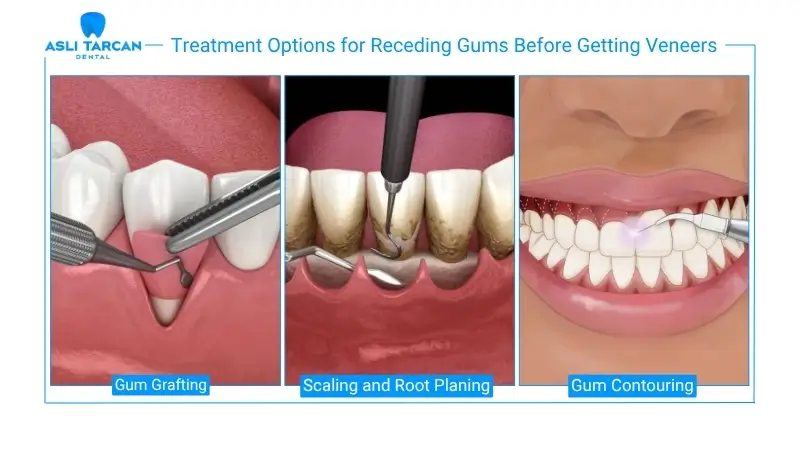 Treatment Options for Receding Gums Before Getting Veneers
