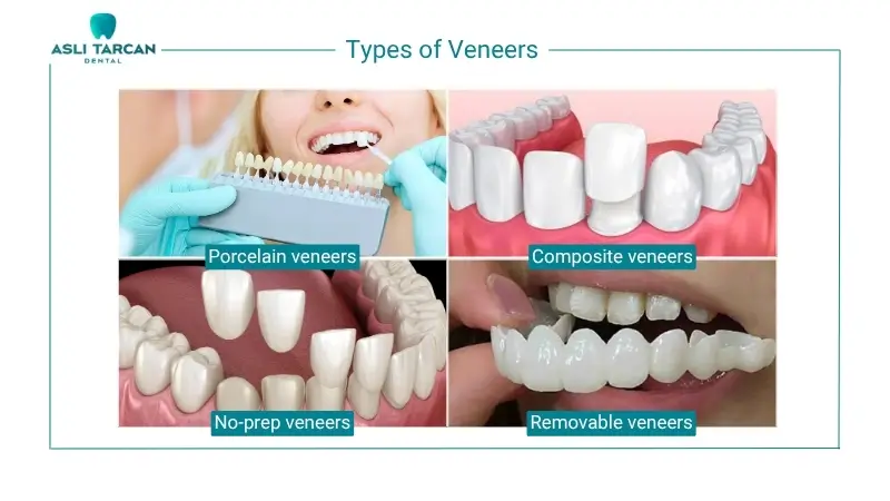Types of Veneers