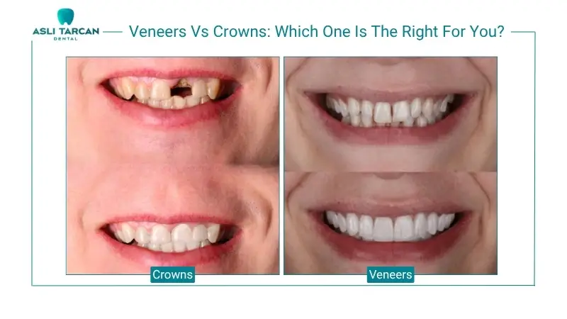 Veneers Vs Crowns Which One Is The Right For You