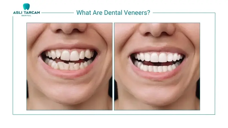 What Are Dental Veneers