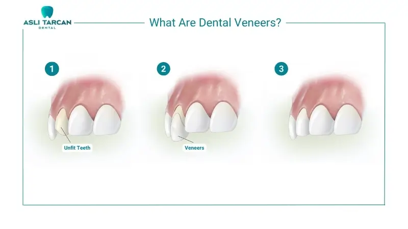 What Are Dental Veneers