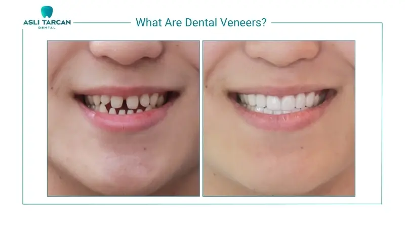 What Are Dental Veneers