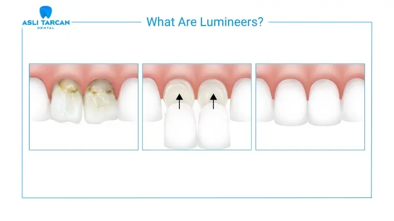 What Are Lumineers