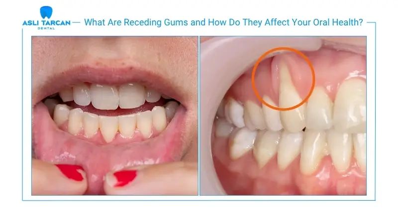 What Are Receding Gums and How Do They Affect Your Oral Health