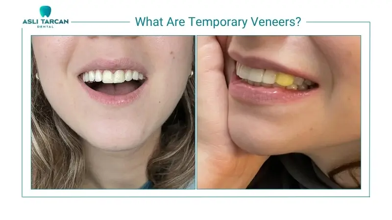 What Are Temporary Veneers