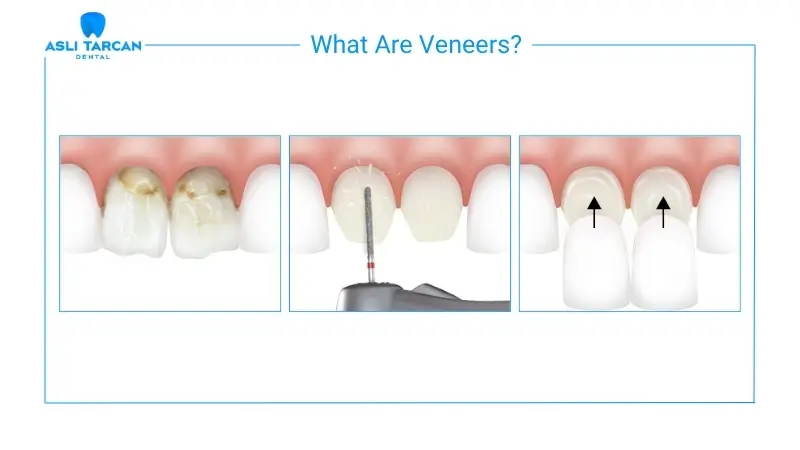 What Are Veneers