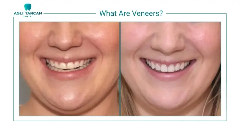 What Are Veneers