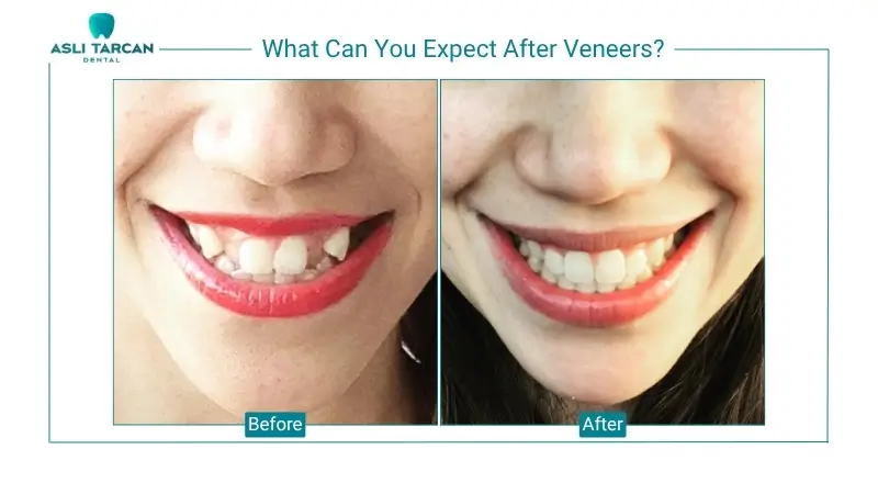 What Can You Expect After Veneers