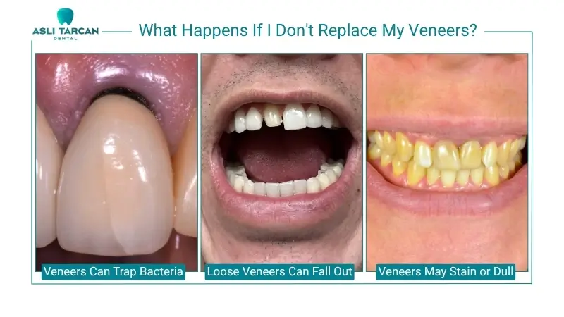 What Happens If I Don't Replace My Veneers 