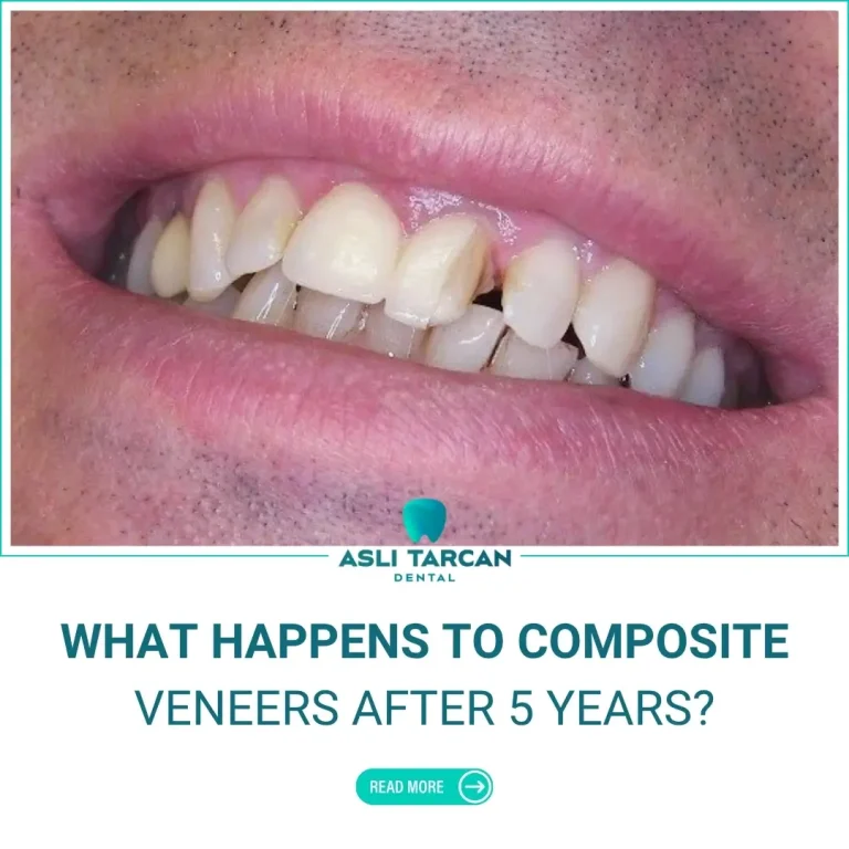 What Happens To Composite Veneers After 5 Years