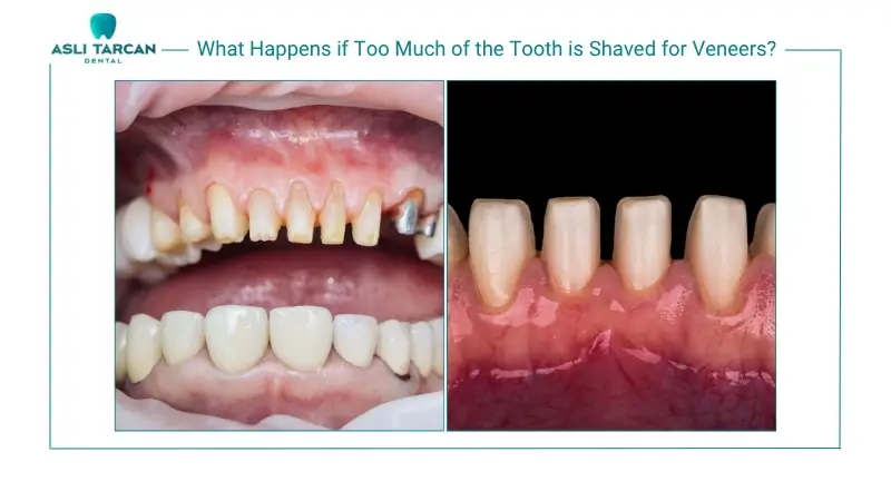 What Happens if Too Much of the Tooth is Shaved for Veneers