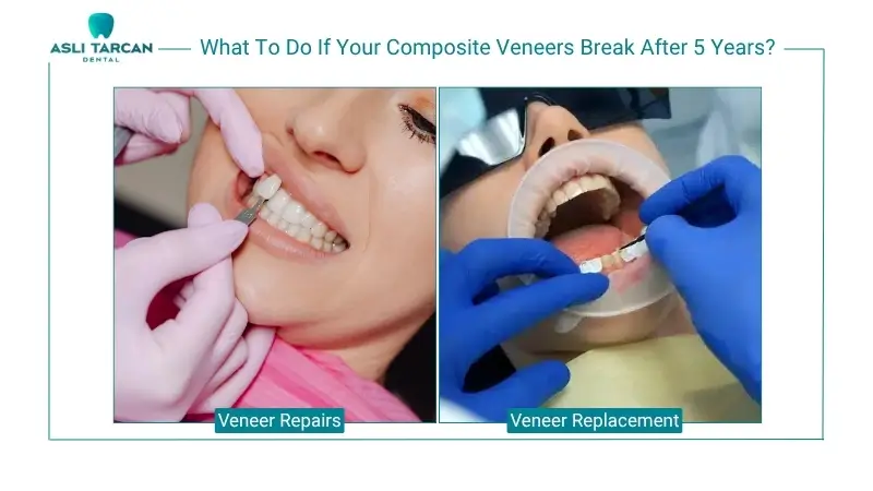 What To Do If Your Composite Veneers Break After 5 Years